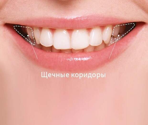 Приглядитесь, нет ли тёмных треугольников в уголках вашей улыбки. Это так называемые щёчные коридоры. Они свидетельствуют о сужение зубных рядов.