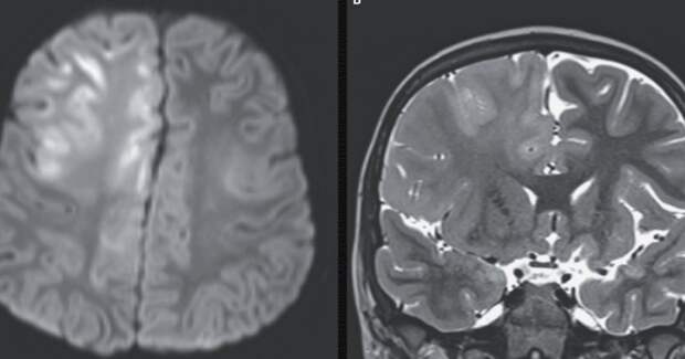 Редкий случай: мальчик умер от посткоревого панэнцефалита спустя годы после заражения