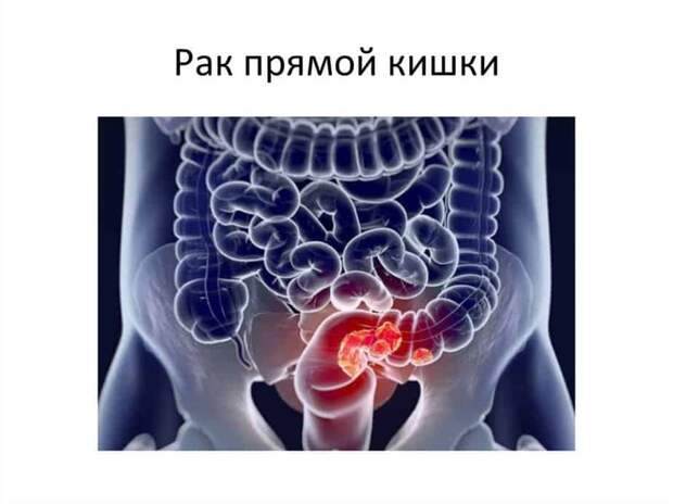 Как выглядит рак прямой кишки фото