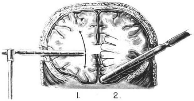 Лоботомия. История потрошения мозгов, или Самая постыдная Нобелевская премия лоботомия, медицина, страницы  истории