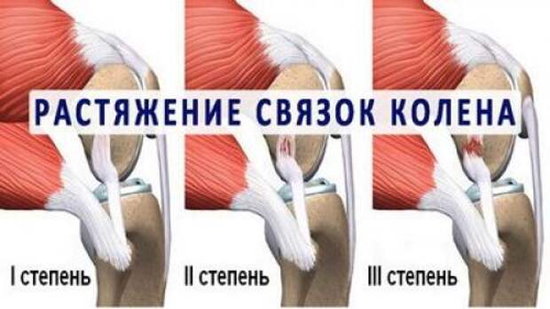 Симптомы и диагностика растяжения связок стопы. Механизм развития 08