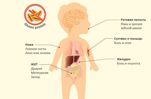 13 неочевидных признаков того, что у вас или ребёнка непереносимость глютена, которые важно знать