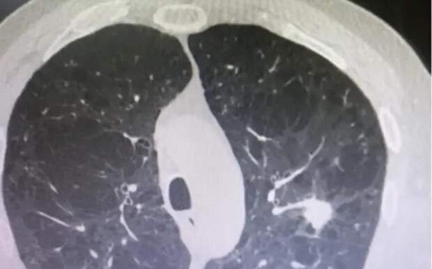 В Рязанском онкодиспансере пациенту удалили вросшую в сосуд опухоль и сохранили легкое