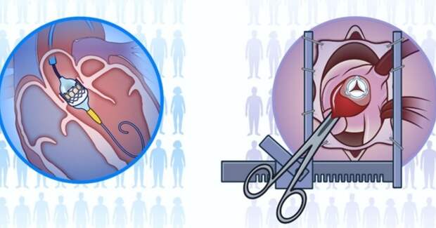 Замена аортального клапана через катетер не снижает риск смерти по сравнению с операцией