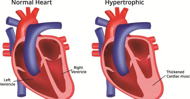 Как прогрессирует гипертрофическая кардиомиопатия у взрослых