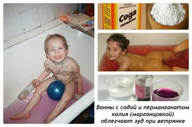 Купание при ветрянке обязательно