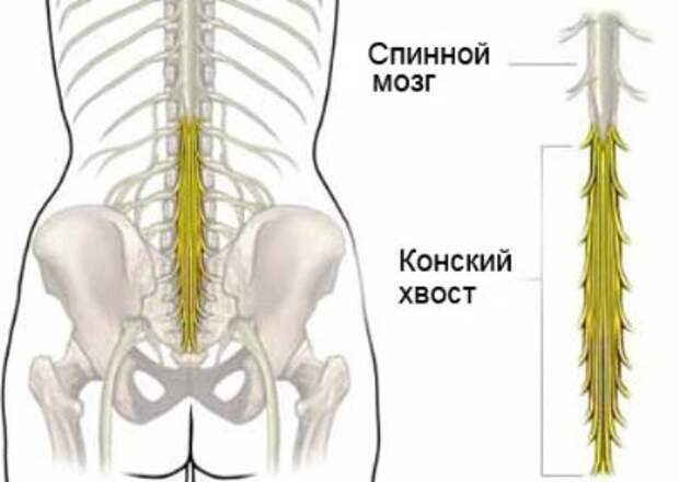 Синдром конского хвоста - сдавление пучка нервных волокон