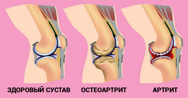 повреждение коленного сустава