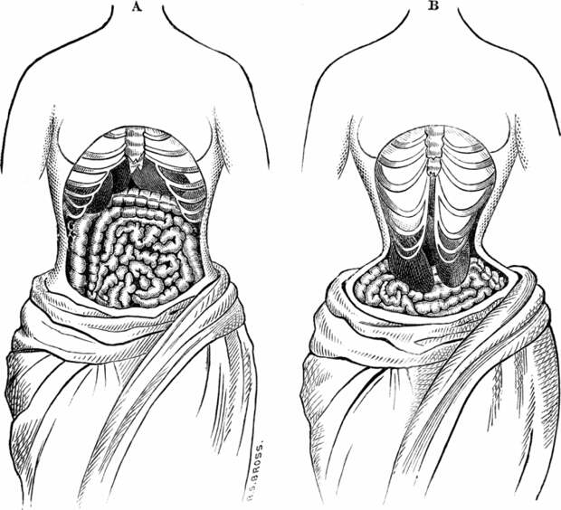Иллюстрацией того, как викторианские врачи представляли себе последствия ношения корсетов. | Фото: commons.wikimedia.org.