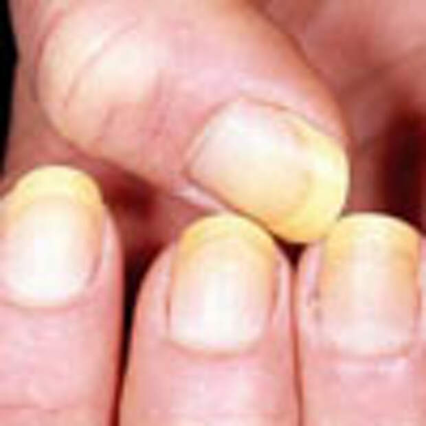Грибок ногтей лечение