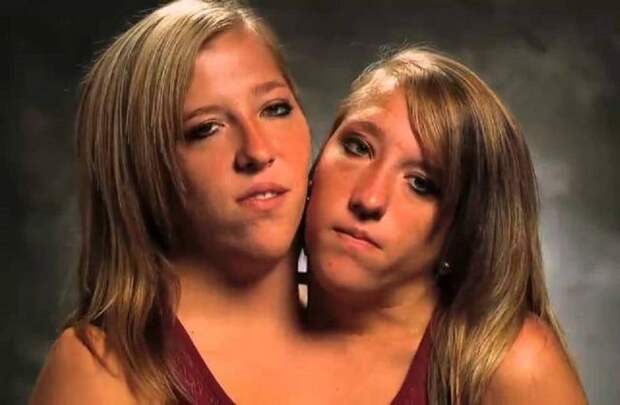 15 интересных фактов о сиамских близняшках Хенсел Хенсел, сиамские близнецы, факт
