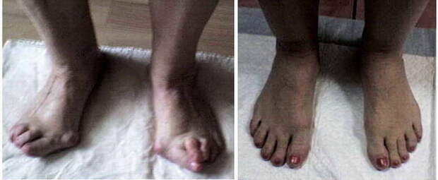 Вальгусная деформация первого пальца стопы до и после операции