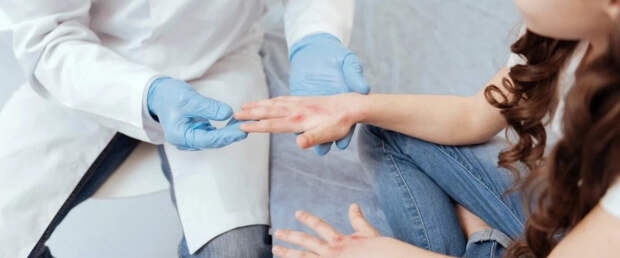 Ученые раскрыли механизм воспаления и зуда при атопическом дерматите