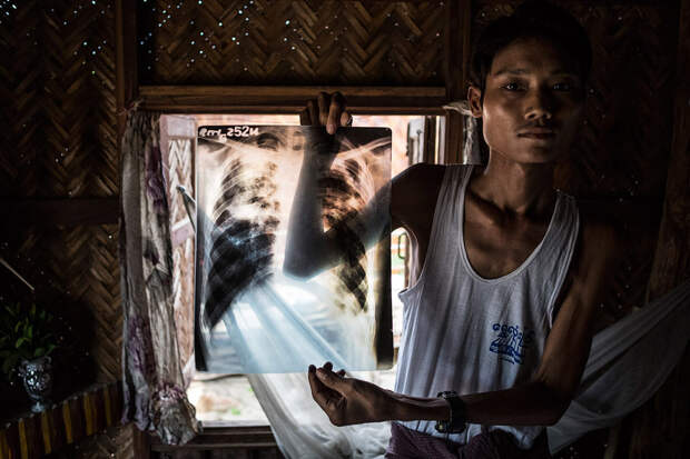 Рентгеновский снимок легких шахтера из Мьянмы