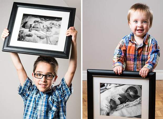 До и после: сильные фото детей, которые появились на свет раньше срока