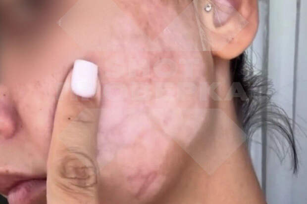 SHOT: в Краснодарском крае девушка едва не задохнулась после фототерапии