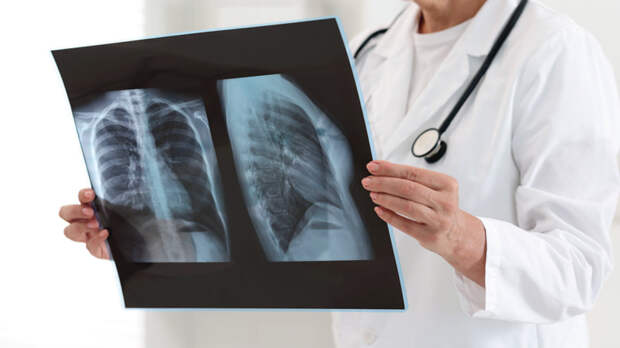 Россия обновила минимум по туберкулезу: 23,9 на 100 тыс.