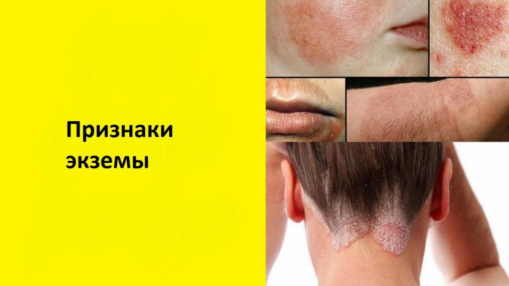 Чем отличается псориаз от экземы: основные различия, причины и методы лечения