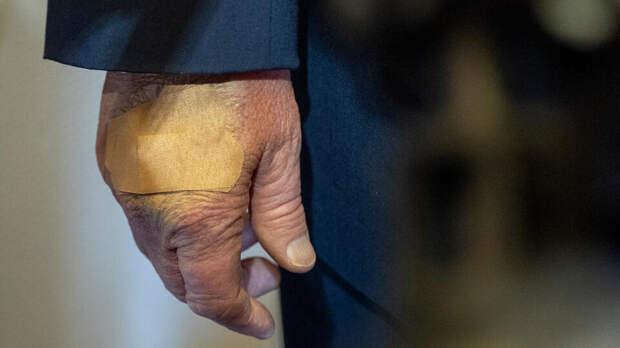 CNN: новые синяки на руках Трампа вызывают вопросы о его здоровье