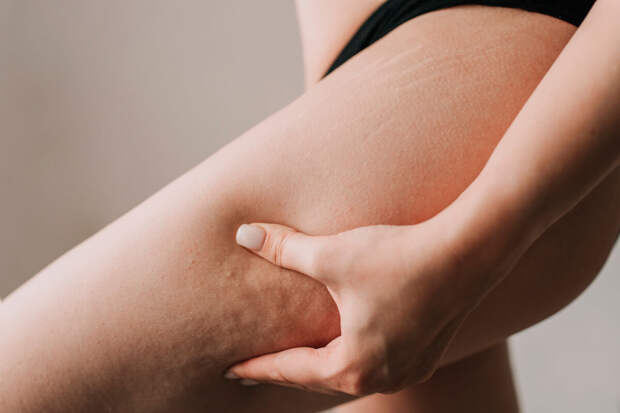 Pravda.Ru: правильное питание поможет в борьбе с целлюлитом