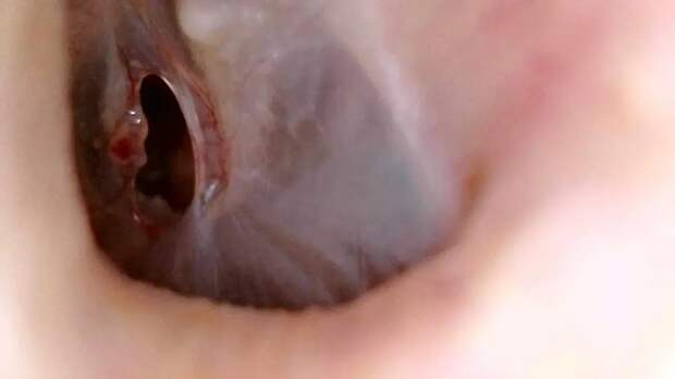 Врачи восстановили слух рязанке после травмы ватной палочкой при чистке ушей