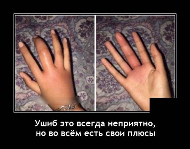 Демотиватор про ушибы