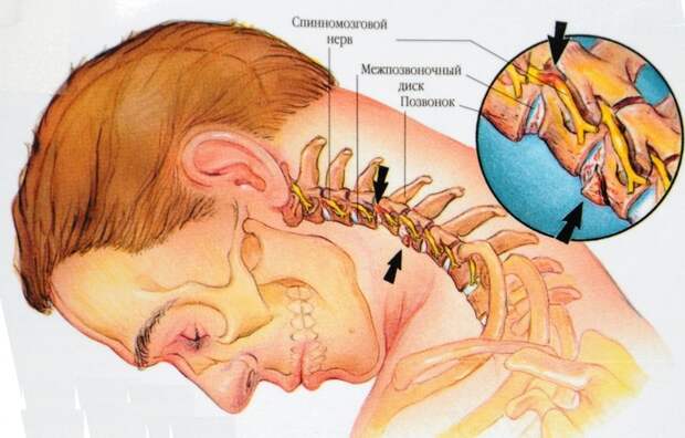 Остеохондроз и другие дегенеративные изменения в позвоночнике могут вызвать боль в шее сзади.