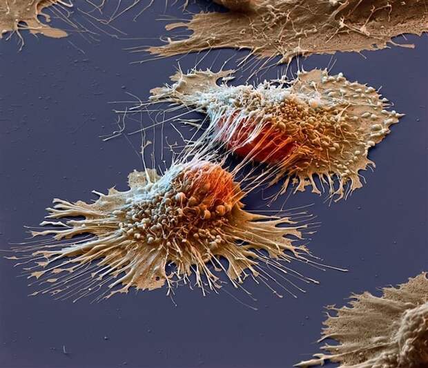 Раковые клетки под электронным микроскопом загадки, интересно, неизведанное, познавательно, тайны
