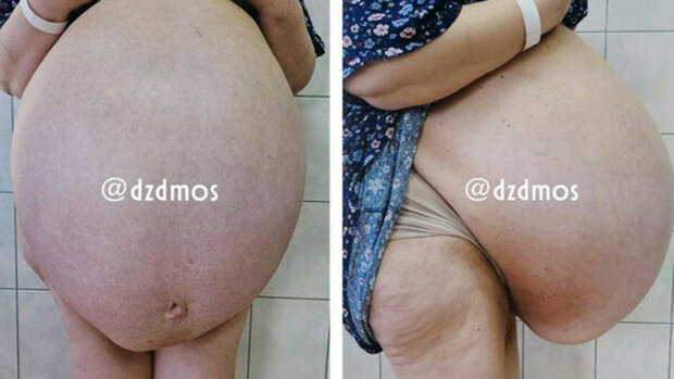 Московские хирурги удалили пациентке кисту размером с фитбол