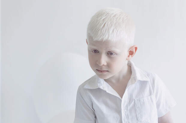 Цезарь альбиносы, красота, люди, фото, фотограф, фотопроект, цвет кожи