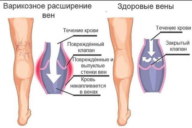 Как я глиной варикоз вылечила - вот такое простое средство!