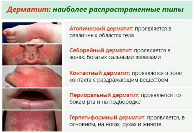 Будет эффективно бит надоевший дерматит - рецепты народные, у врачей немодные. А людям излечиться помогают!