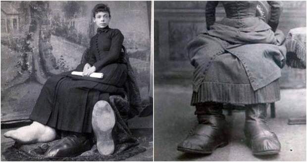 Уродства вечная печать: трагическая судьба «девушки с большими ногами из Огайо»