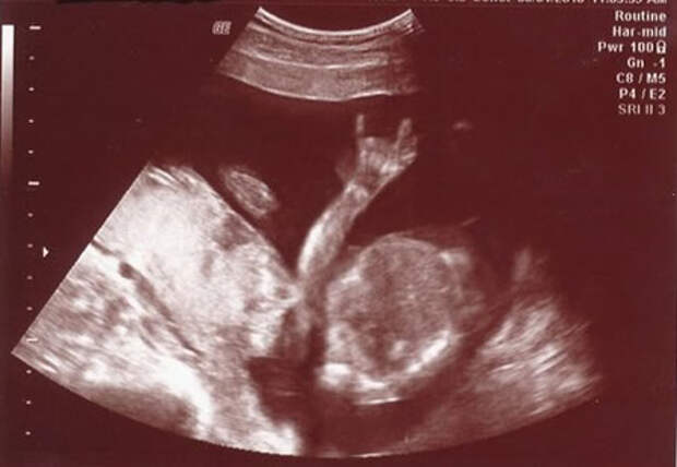 Картинки по запросу baby rocks ultrasound