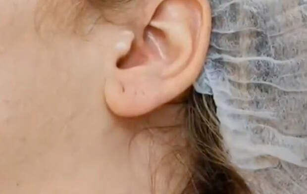 Москвички начали колоть ботокс в уши ради похудения