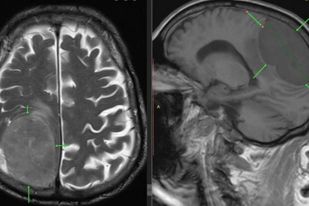 В Пятигорске врачи спасли пенсионера с огромной опухолью мозга