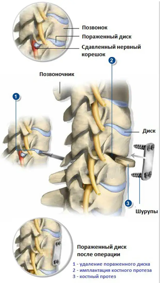 Операция по удалению грыжи позвоночника поясничного. Операций грыжа диска позвоночника. Грыжа межпозвоночного диска поясничного отдела операция. Операция на диски позвоночника. Грыжа шейного отдела операция.