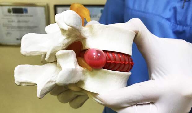 Как организм сам избавляется от грыжи позвоночника