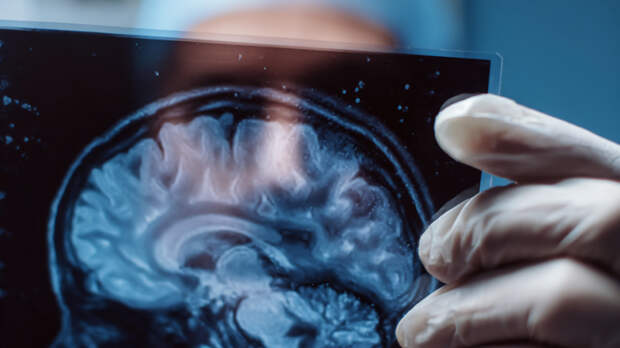 «Очень агрессивна»: врач назвала симптомы глиобластомы