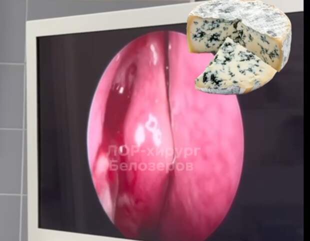 В Нижнем Новгороде прооперировали сыровара с грибком в носу