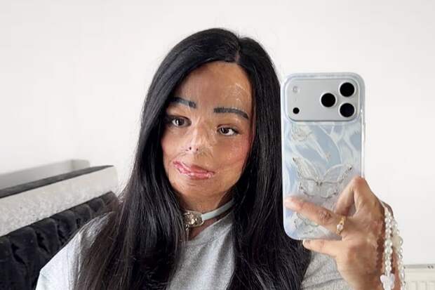 Mirror: в Англии девушка получила ожоги из-за загоревшегося на голове шампуня