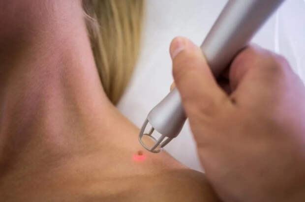 Ирландке диагностировали рак кожи третьей степени из-за солярия