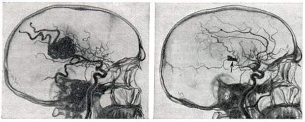 Операции на головном мозге Медицина, Мозг, Операция, Длиннопост, Текст, Картинки, Жесть