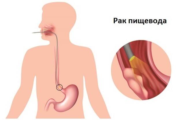 Симптомы основных заболеваний пищевода