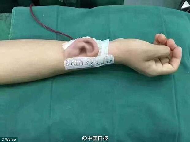 Китайский врач вырастил для пациента новое ухо китай, медицина, операция, пластическая хирургия