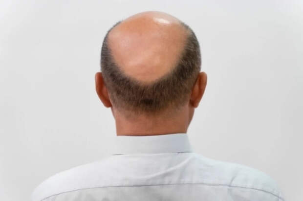 Трихолог Галлямова развеяла два распространенных мифа о выпадении волос