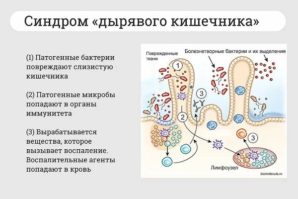 Синдром дырявого кишечника