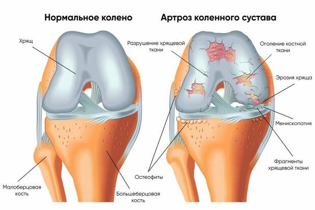 Остеоартрит, остеопороз и остеопения: в чем разница?