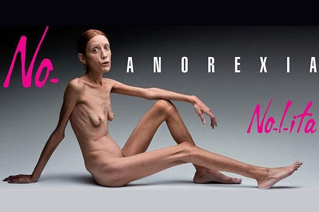 Anorexia06 8 знаменитостей, умерших от анорексии