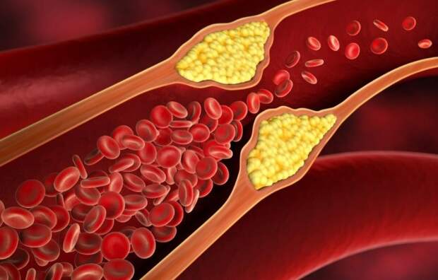 Невролог Чудинская: высокий уровень «плохого» холестерина в крови грозит инсультом